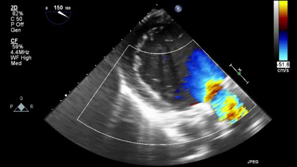 Ultrasound Transesophageal Pemeriksaan Jantung — Stok Video