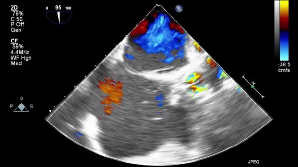 Exame Transesofágico Ultrassonográfico Coração — Vídeo de Stock