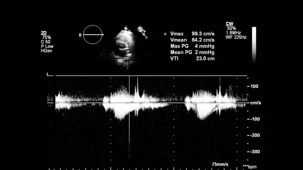 Obrázek Srdce Šedém Měřítku Během Transesofageálního Ultrazvuku — Stock fotografie