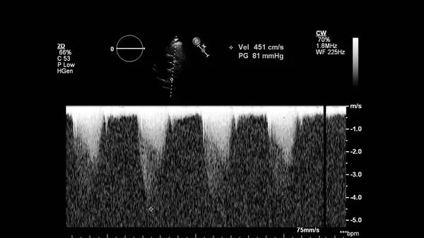 Image Cœur Mode Gris Lors Une Échographie Transœsophagienne — Photo