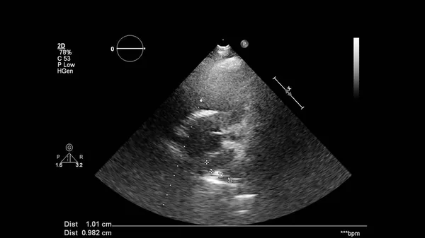 Image of the heart in gray-scale mode during transesophageal ultrasound.