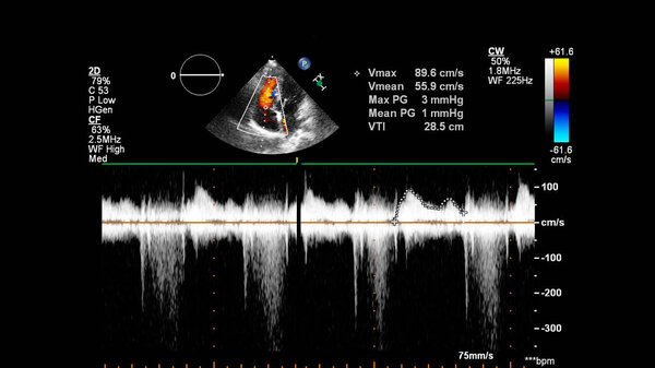 Изображение сердца во время трансофагеального ультразвука с доплеровским режимом.