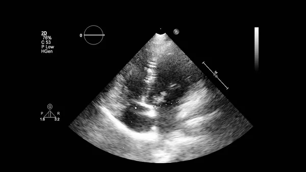 Transesofageal Ultrason Sırasında Kalbin Gri Ölçekli Görüntüsü — Stok fotoğraf