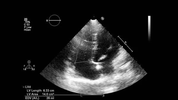 Transesofageal Ultrason Sırasında Kalbin Gri Ölçekli Görüntüsü — Stok fotoğraf