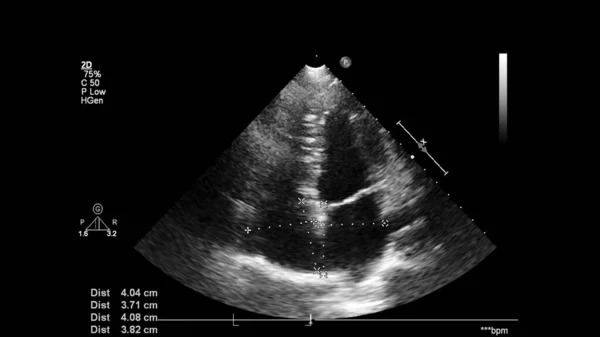 Transesofageal Ultrason Sırasında Kalbin Gri Ölçekli Görüntüsü — Stok fotoğraf