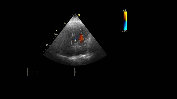Image Heart Transesophageal Ultrasound Doppler Mode — Stock Photo, Image