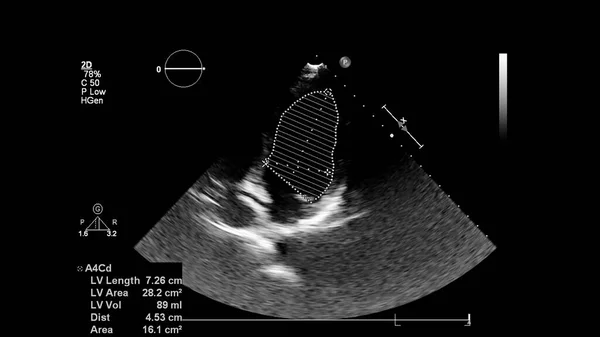 Image Cœur Mode Gris Lors Une Échographie Transœsophagienne — Photo