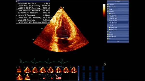 Изображение Сердца Сером Режиме Время Трансофагеального Ультразвука — стоковое фото