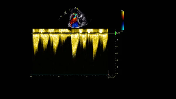 Imagem Coração Durante Ultrassom Transesofágico Com Modo Doppler — Fotografia de Stock