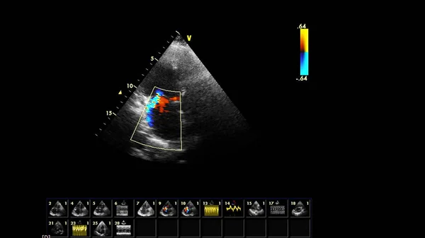 Imagem Coração Durante Ultrassom Transesofágico Com Modo Doppler — Fotografia de Stock