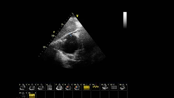 Transesofageal Ultrason Sırasında Kalbin Gri Ölçekli Görüntüsü — Stok fotoğraf