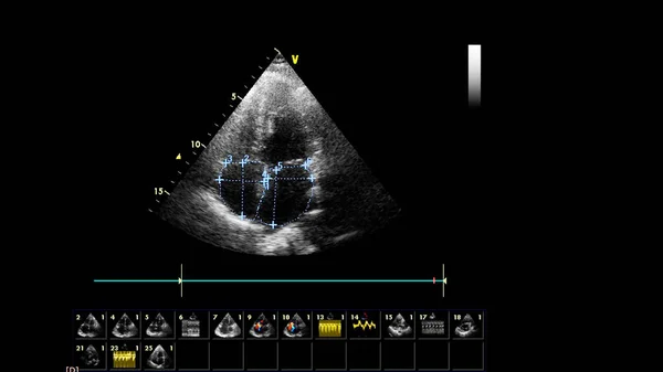 Transesofageal Ultrason Sırasında Kalbin Gri Ölçekli Görüntüsü — Stok fotoğraf