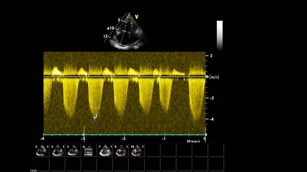 Transesofageal Ultrason Sırasında Kalbin Gri Ölçekli Görüntüsü — Stok fotoğraf