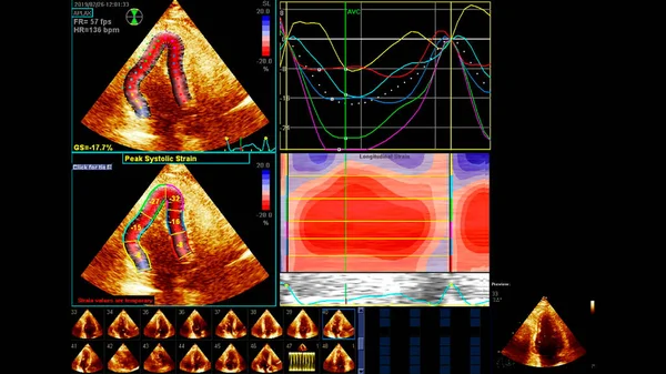 Transesofageal Ultrason Sırasında Kalbin Gri Ölçekli Görüntüsü Stok Fotoğraf