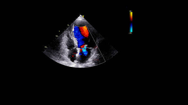 Image of the heart during transesophageal ultrasound with Doppler mode.