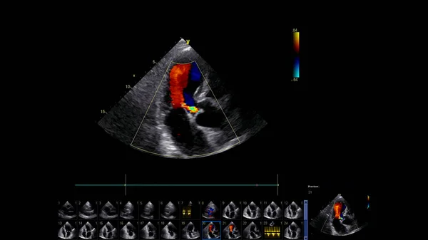 Beeld Van Het Hart Tijdens Transesofageale Echografie Met Doppler Modus — Stockfoto