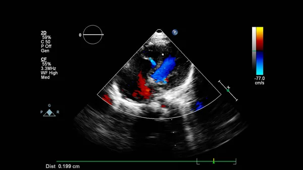 Imagem Coração Durante Ultrassom Transesofágico Com Modo Doppler — Fotografia de Stock