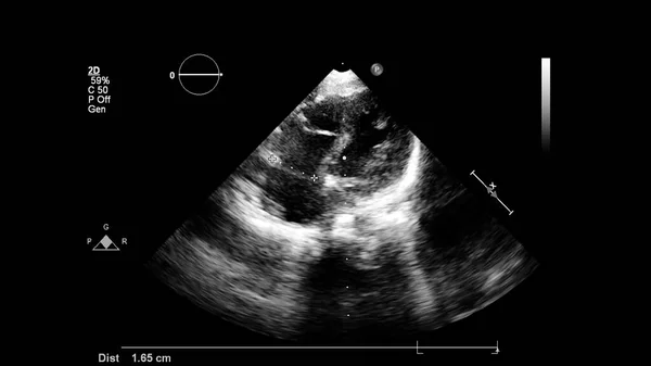 Image Cœur Mode Gris Lors Une Échographie Transœsophagienne — Photo