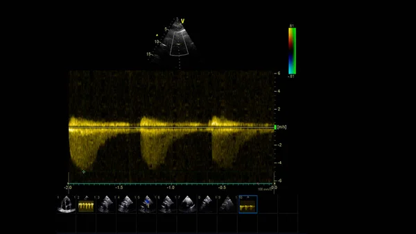 Imagem Coração Durante Ultrassom Transesofágico Com Modo Doppler — Fotografia de Stock