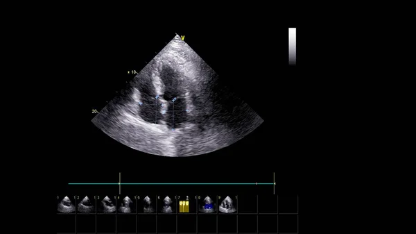 Image of the heart in gray-scale mode during transesophageal ultrasound.