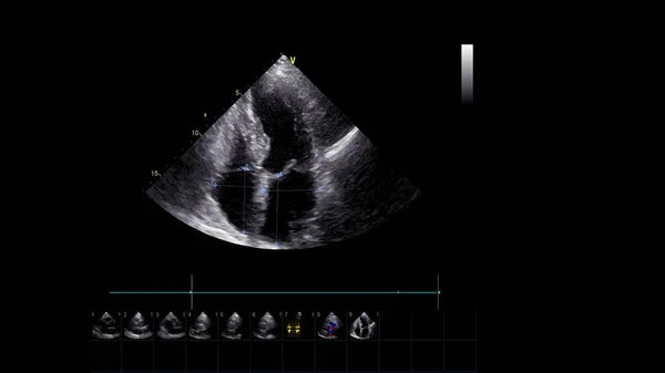 Transesofageal Ultrason Sırasında Kalbin Gri Ölçekli Görüntüsü — Stok fotoğraf