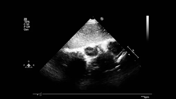 Transesofageal Ultrason Sırasında Kalbin Gri Ölçekli Görüntüsü — Stok fotoğraf