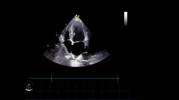 Imagem Coração Escala Cinza Durante Ultrassonografia Transesofágica — Fotografia de Stock