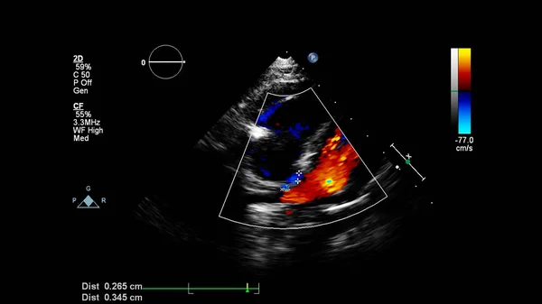 Transesofageal ultrason sırasında Doppler kipi ile kalbin görüntüsü.