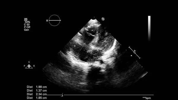 Transesofageal Ultrason Sırasında Kalbin Gri Ölçekli Görüntüsü — Stok fotoğraf