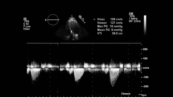 Image of the heart in gray-scale mode during transesophageal ultrasound.