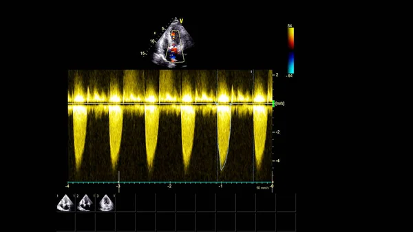 Imagem Coração Durante Ultrassom Transesofágico Com Modo Doppler — Fotografia de Stock