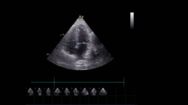 Image of the heart in gray-scale mode during transesophageal ultrasound.