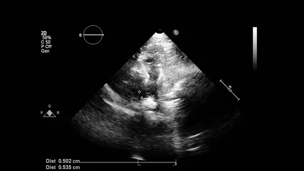 Obrázek Srdce Šedém Měřítku Během Transesofageálního Ultrazvuku — Stock fotografie