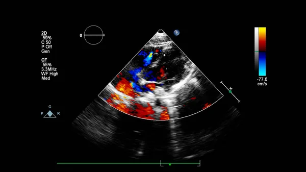 Imagem Coração Durante Ultrassom Transesofágico Com Modo Doppler — Fotografia de Stock