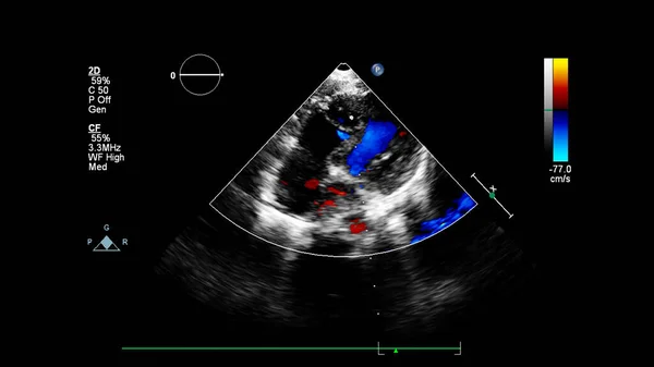 Imagem Coração Durante Ultrassom Transesofágico Com Modo Doppler — Fotografia de Stock