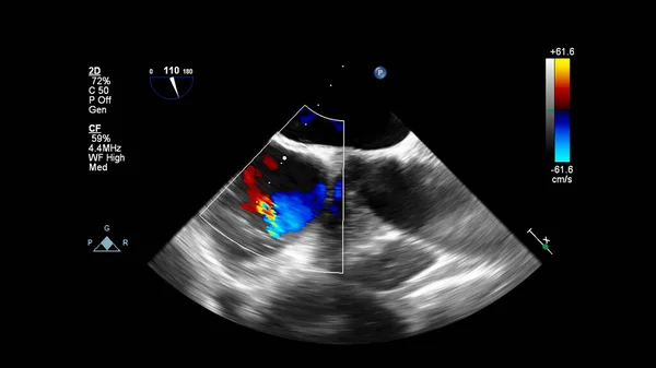 Immagine Del Cuore Durante Ecografia Transesofagea Con Modalità Doppler — Foto Stock