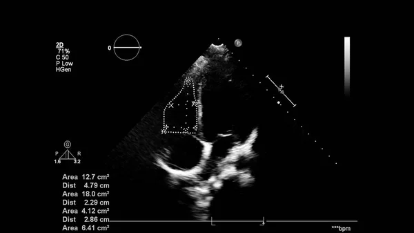 Transesofageal Ultrason Sırasında Kalbin Gri Ölçekli Görüntüsü — Stok fotoğraf