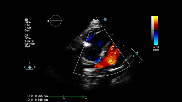 Transesofageal Ultrason Sırasında Doppler Kipi Ile Kalbin Görüntüsü Telifsiz Stok Imajlar