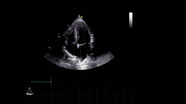 経食道超音波検査時のグレースケールモードで心臓の画像 ストック画像