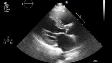 Kalbin ultrason transsofageal muayenesi.