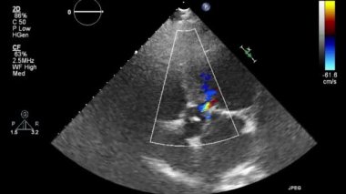 Kalbin ultrason transsofageal muayenesi.