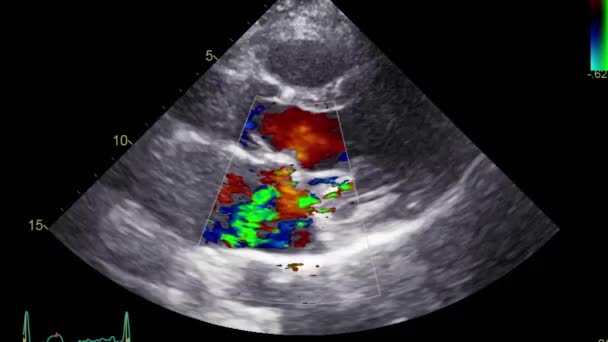 Echografie Transslokdarmonderzoek Van Het Hart — Stockvideo