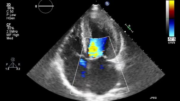 Ultraschall Transesophageale Untersuchung Des Herzens — Stockvideo