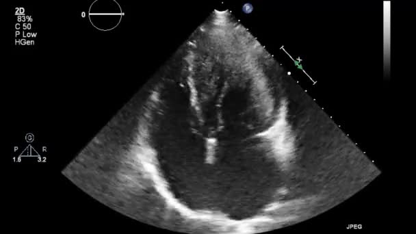 Usg Przełyku Przełyku Serca — Wideo stockowe
