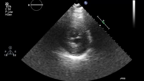 Echografie Transslokdarmonderzoek Van Het Hart — Stockvideo