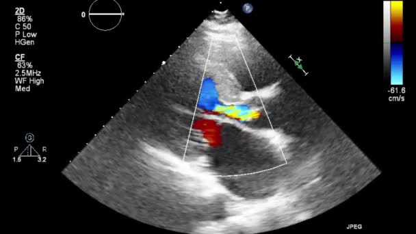 Ultralyd Transesophageal Undersøgelse Hjertet – Stock-video