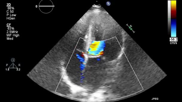 Ecografia Esame Transesofageo Del Cuore — Video Stock