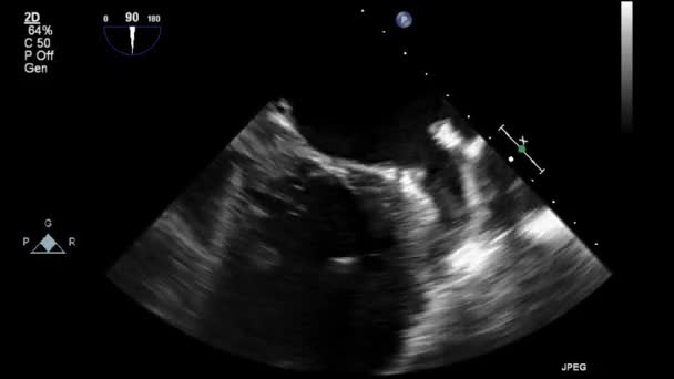 Ecografía Examen Transesofágico Del Corazón — Vídeos de Stock