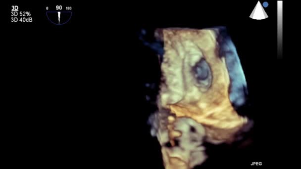 Ultrasound Transesophageal Examination Heart — Stock Video