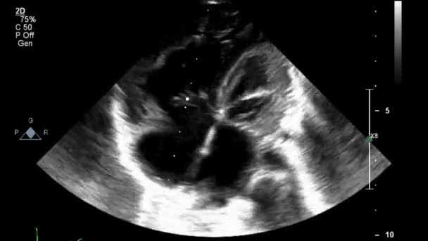 心臓の超音波経食道検査 — ストック動画